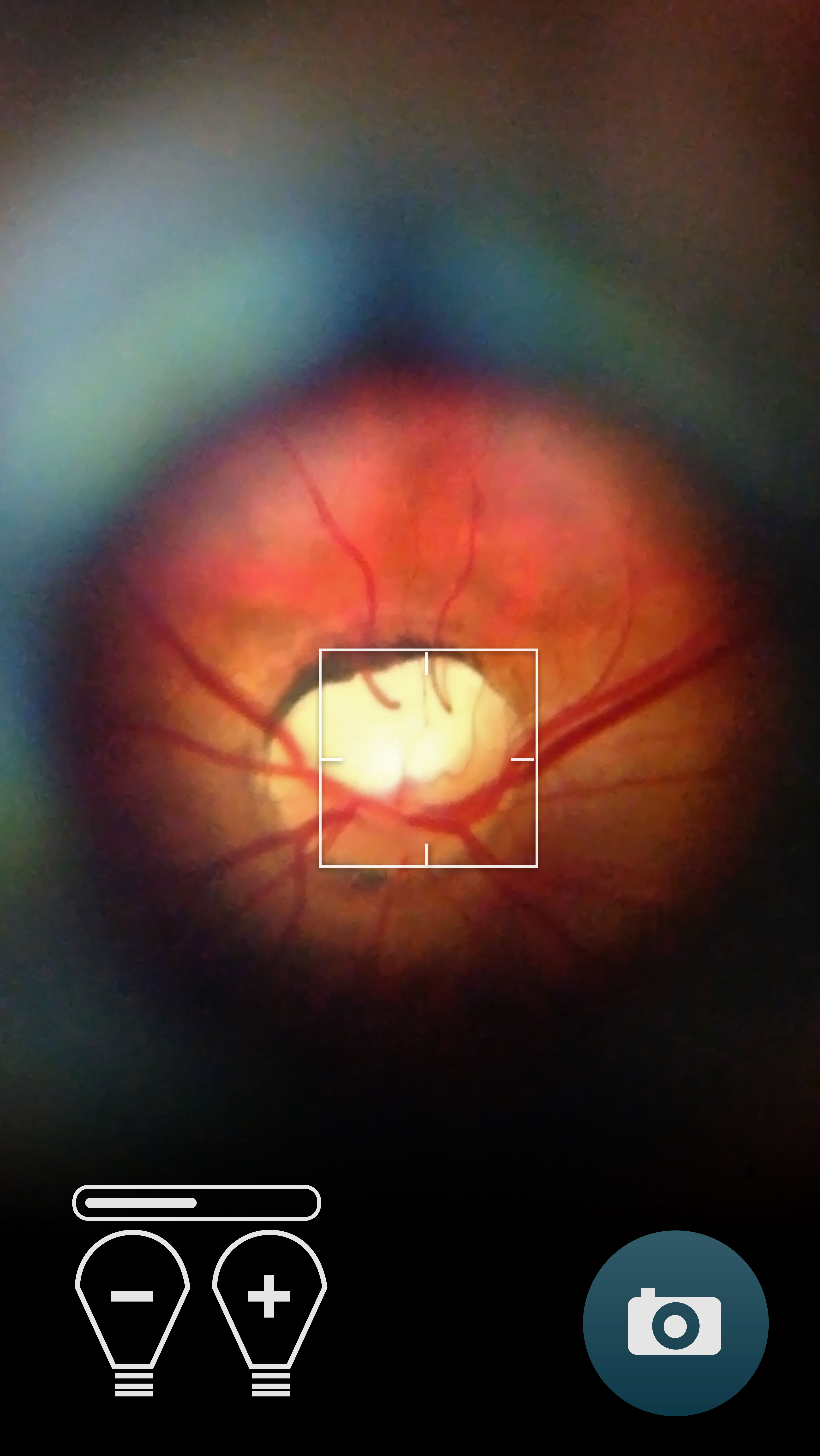 iPhone5 close up of screen view of optic nerve disc using the D-EYE Portable Retinal Imaging System