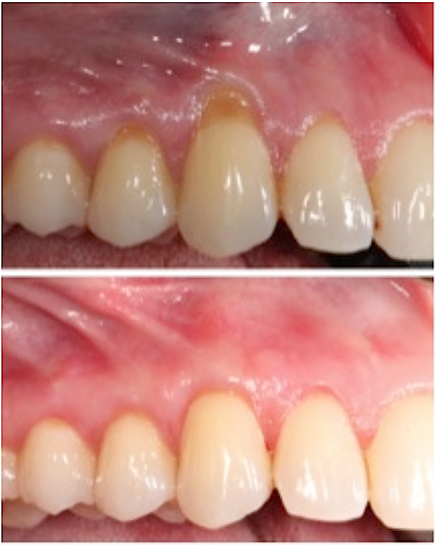 RejuvaGum Lift™ before and after