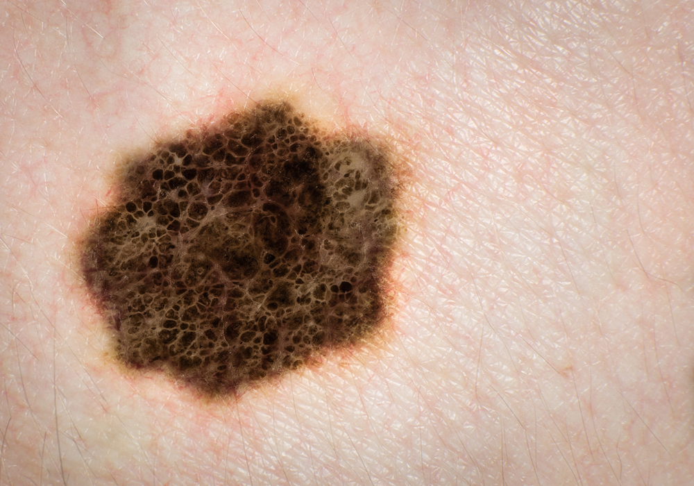 Melanoma, the most deadly skin cancer, is preventable.