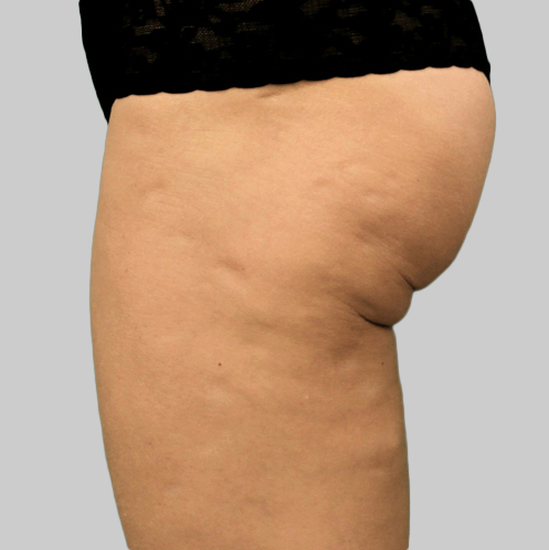 Before Exilis Treatment of Thighs