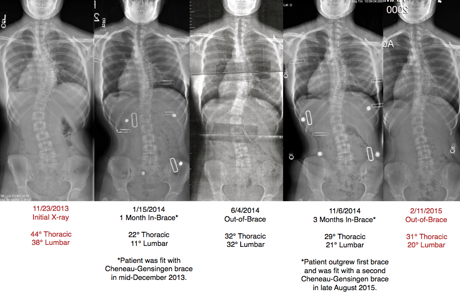 Teenage girl reduces scoliosis curve with Schroth scoliosis exercises and Gensingen brace.