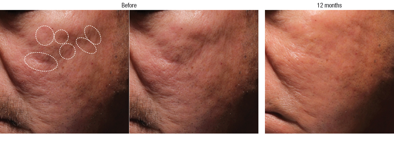 Before and After Acne Scar Treatment with Bellafill