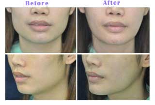 Botox for Jaw Redution at Trifecta Med Spa