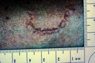 Forensic picture of a bite mark seen wtih the SDFI Negative Invert Filter