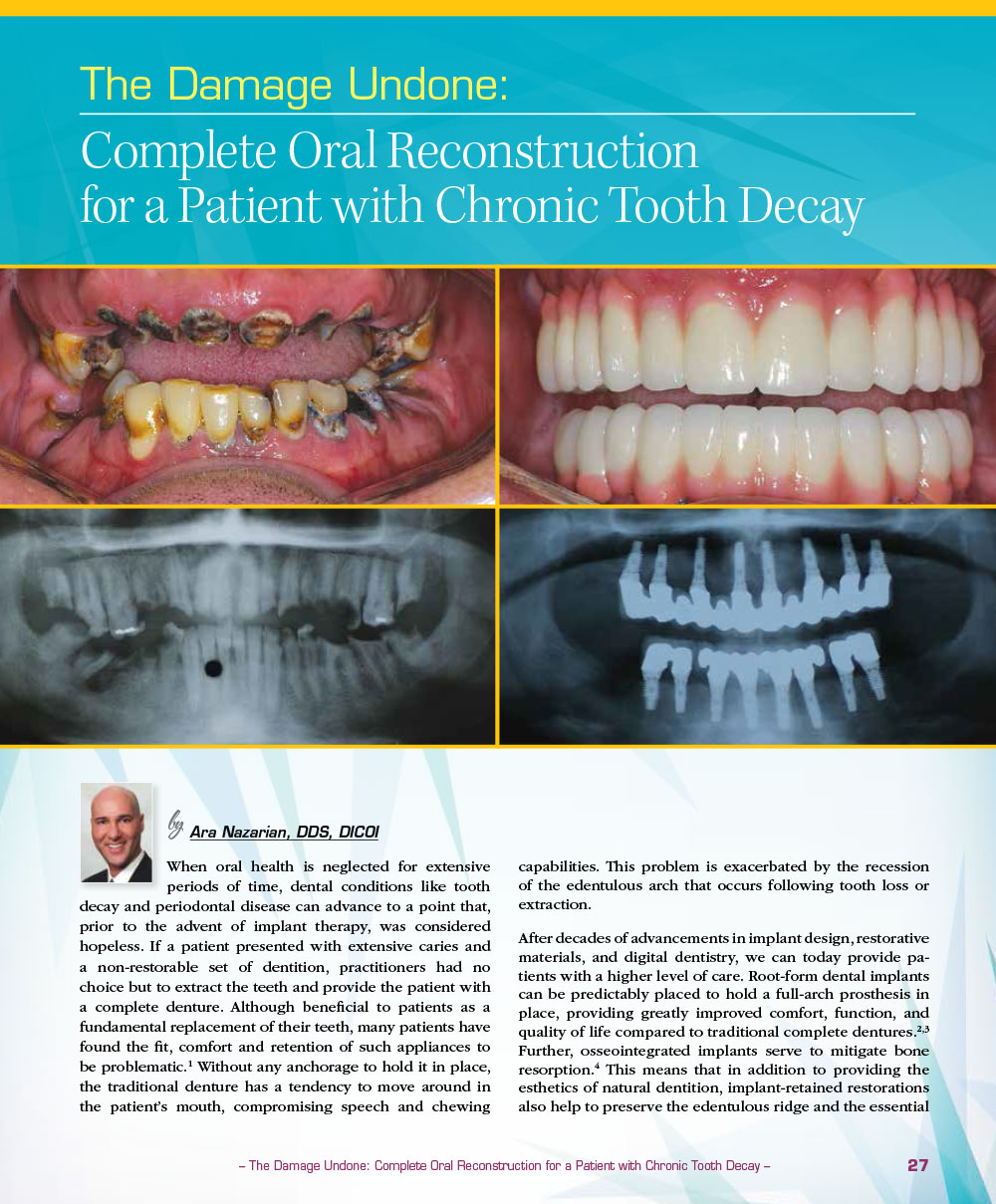 The Damage Undone: Complete Oral Reconstruction for a Patient with Chronic Tooth Decay