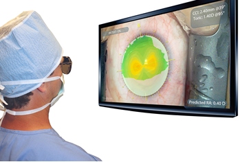 The new axial mapping gives supplementary details for astigmatism treatment.