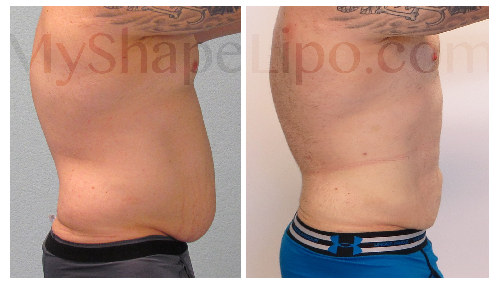 Male Liposuction of Abdomen