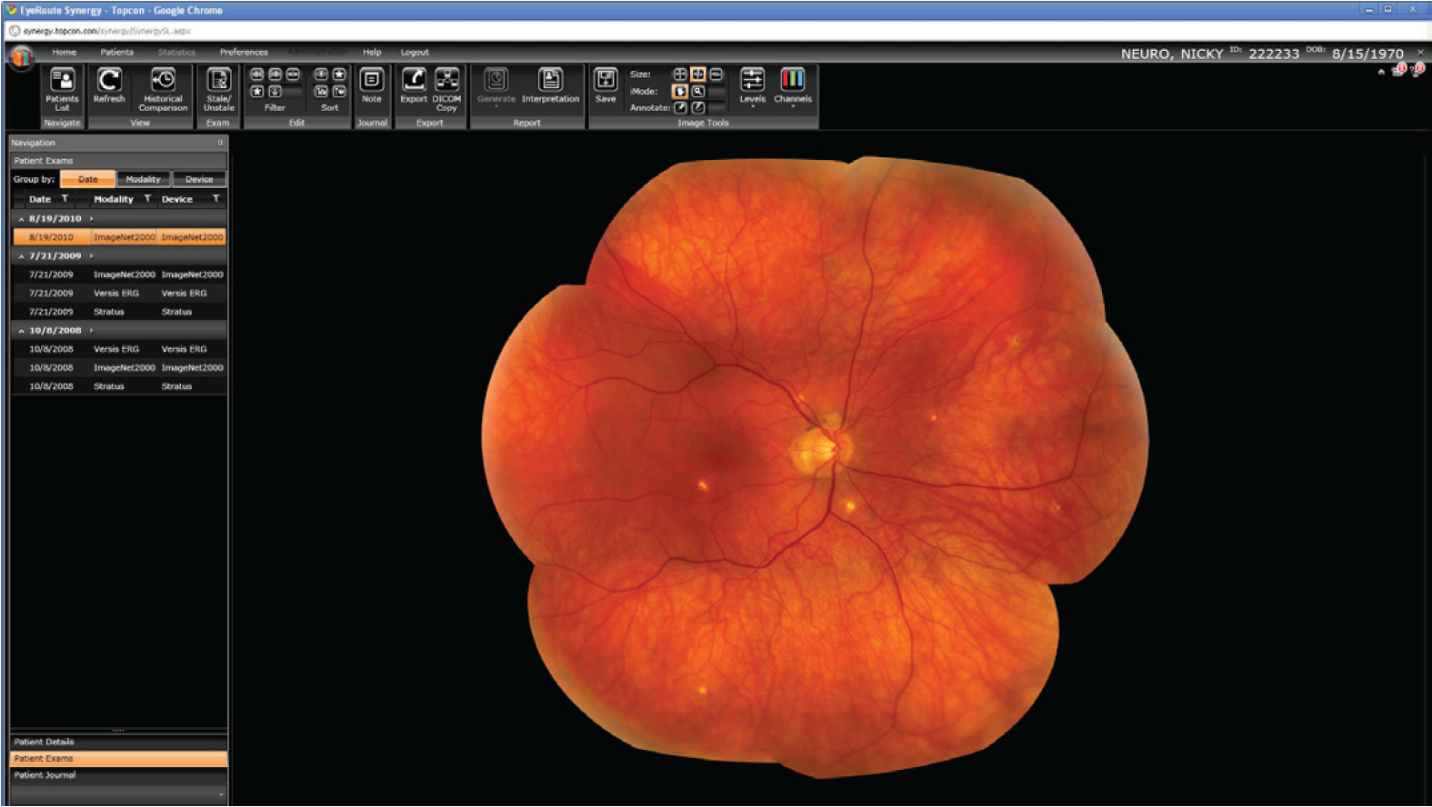 Using Synergy, iMedicware users can stitch together a series of images in order to view a wide area of the retina.