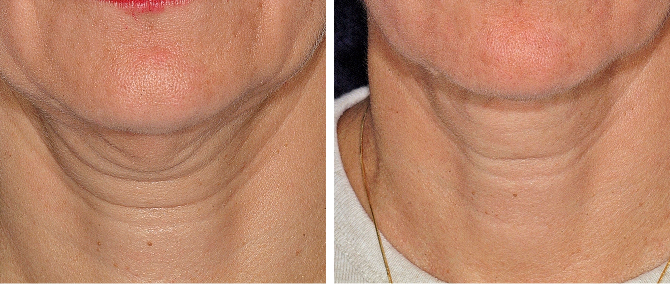 thermage before and after neck jaw line lower face