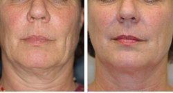 Thermage for non-surgical face lifts and to tighten loose skin was the ...