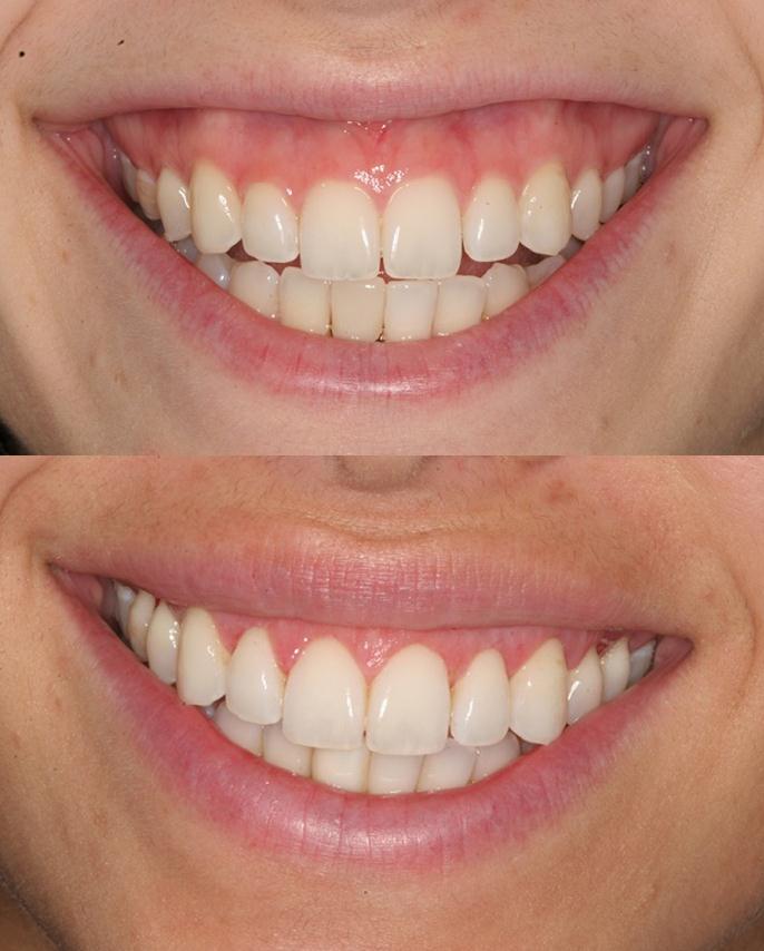 A Lip Repositioning Procedure Brought The Lip Down To Minimize Gum Exposure