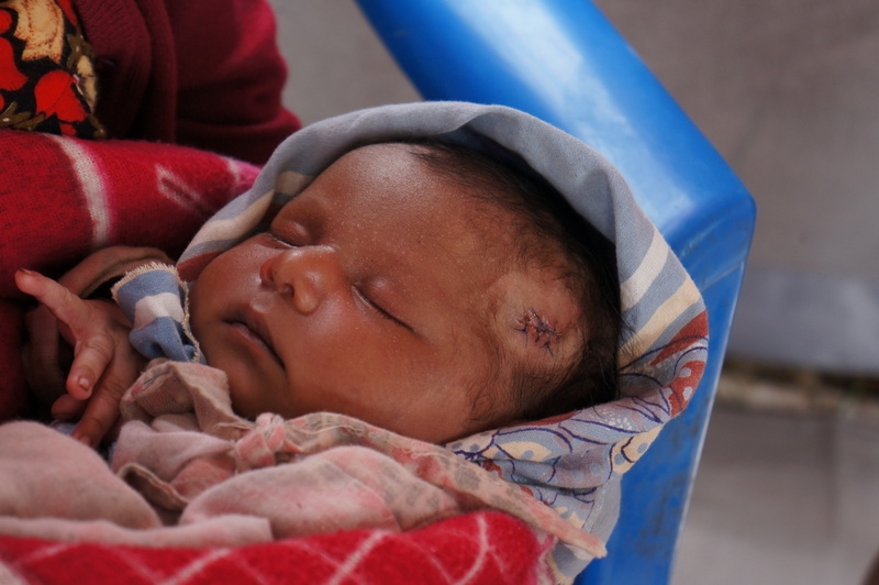 Nepalese infant after receiving first aid.