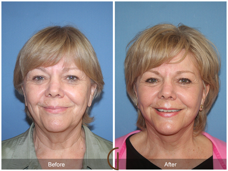 Facelift Under Local Anesthesia, No General Anesthesia Needed