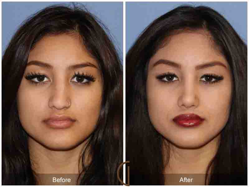 Teen Rhinoplasty Actual Patient - Before and After