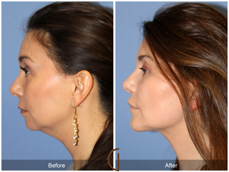 Blepharoplasty, Fat Grafting and Chin Augmentation Actual Patient Before and After