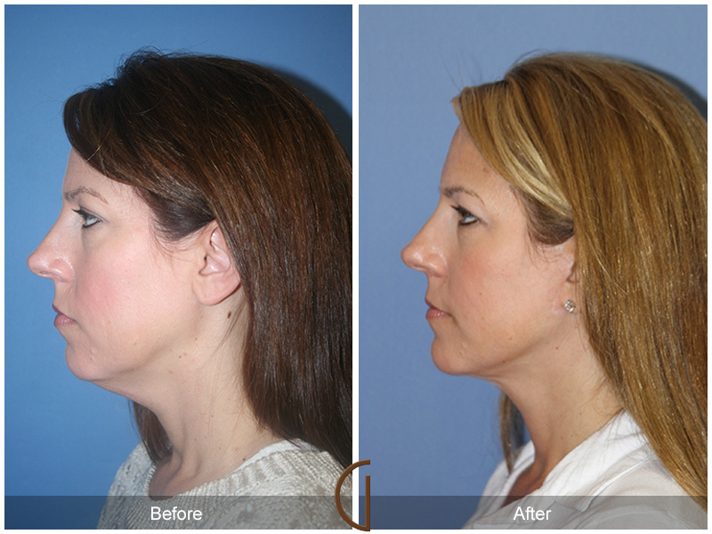 Minimally Invasive Lower Face and Neck Lift