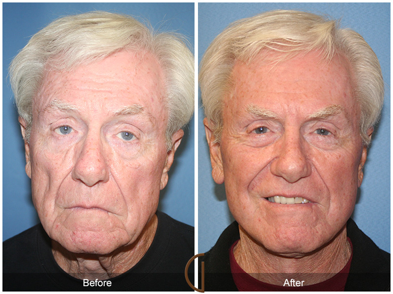 Male Lower Facelift & Neck Lift Patient