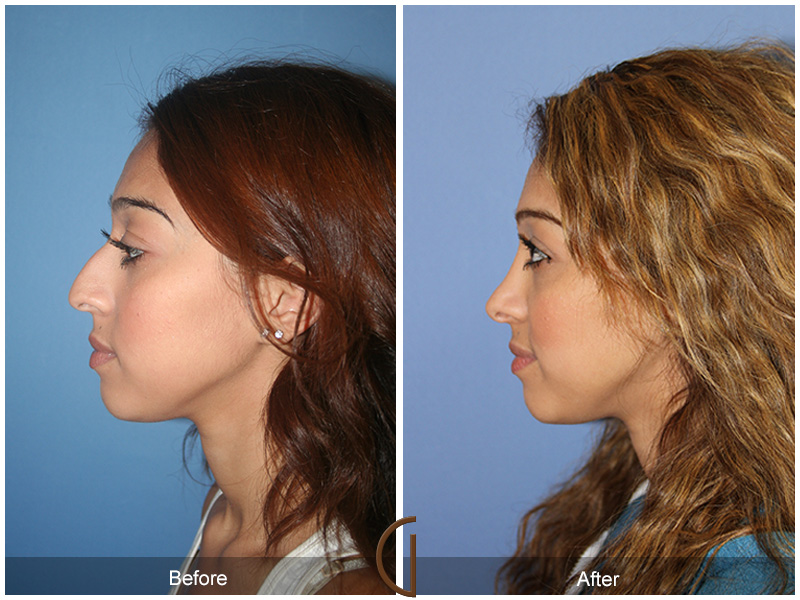 Teenage Rhinoplasty Patient - Before and After Photo