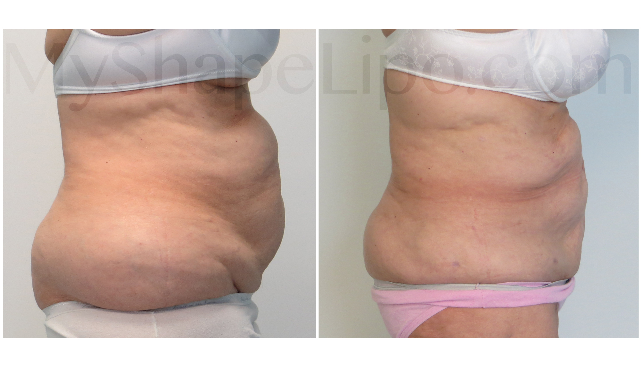 11 inch waist reduction