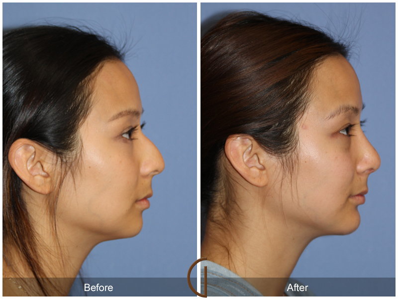 Rhinoplasty & Chin Implant - Plastic Surgery