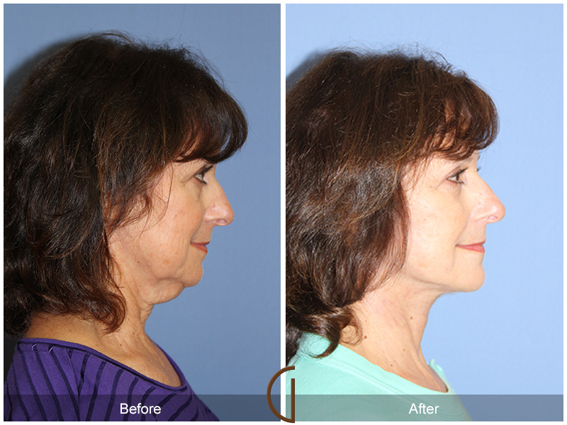 Facelift by Top Newport Beach Facial Plastic Surgeon