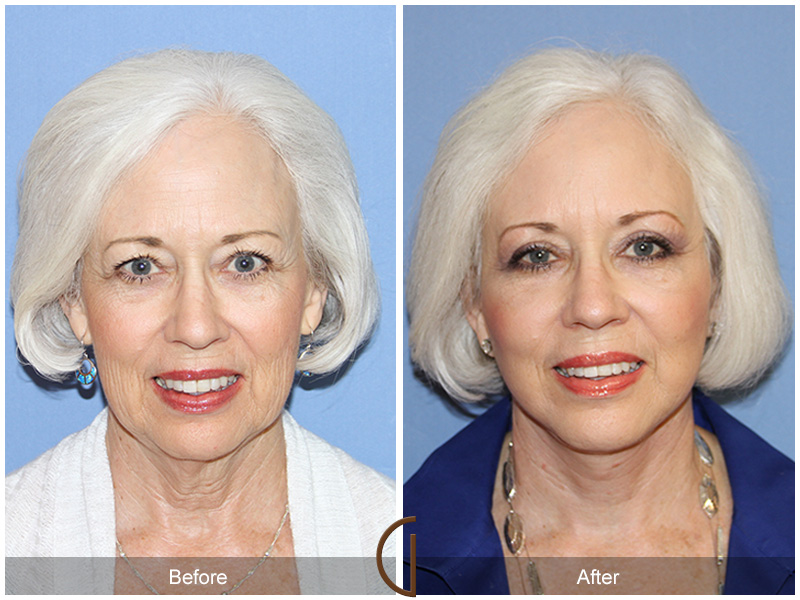 Facelift & Blepharoplasty - Cosmetic Surgery in California