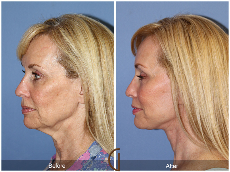 Lower Facelift and Neck Lift - Orange County Facial Plastic Surgeon