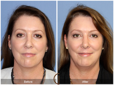 Tip Rhinoplasty by Top Orange County Facial Plastic Surgeon Dr. Kevin Sadati