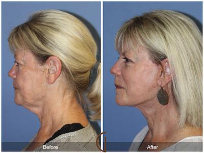 Facelift in Newport Beach California by Top Facial Plastic Surgery, Dr. Kevin Sadati