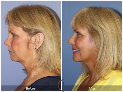 Lower Facelift and Neck Lift with Dr. Kevin Sadati in Newport Beach, California