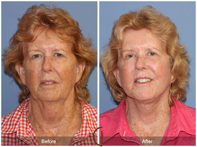 Facelift in Newport Beach California by Top Facial Plastic Surgery, Dr. Kevin Sadati