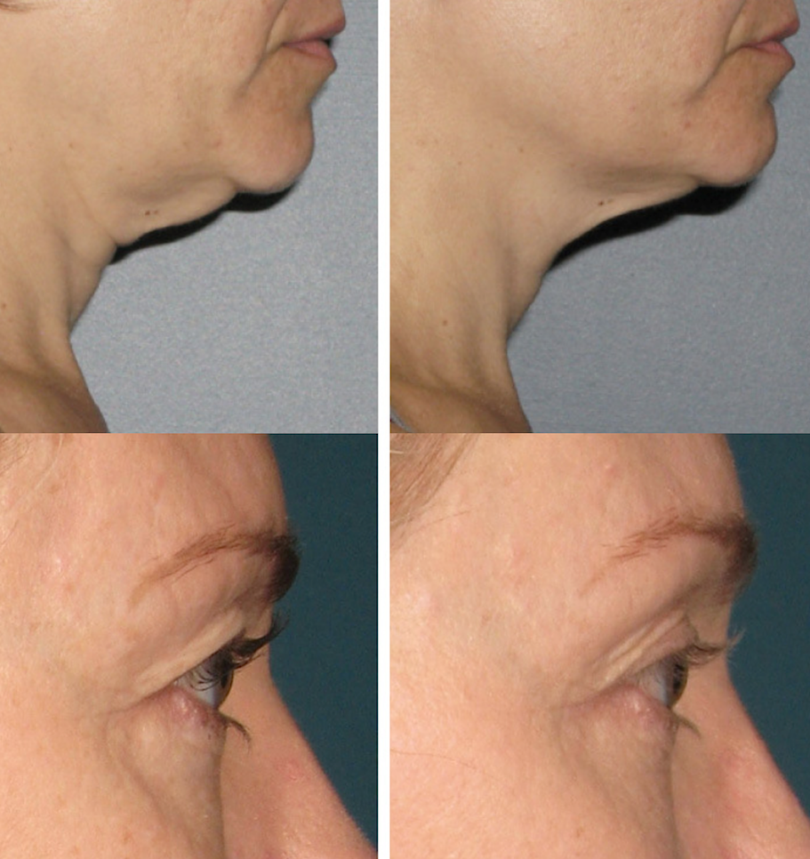 Dr. Patel shows examples of results with Ultherapy for eyelids and neck