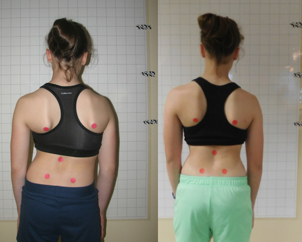 The Gensingen Brace® and Schroth Method - Best Practice Program Can Help Improve Posture and Reduce Scoliosis Curvature