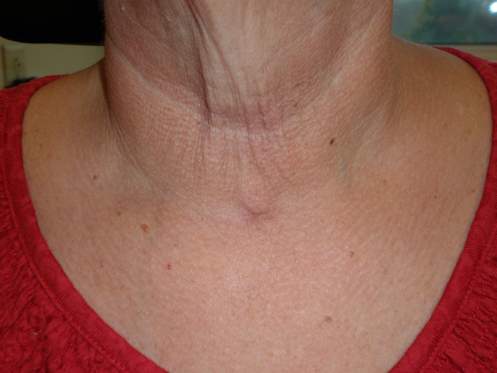 Total Thyroidectomy healed incision