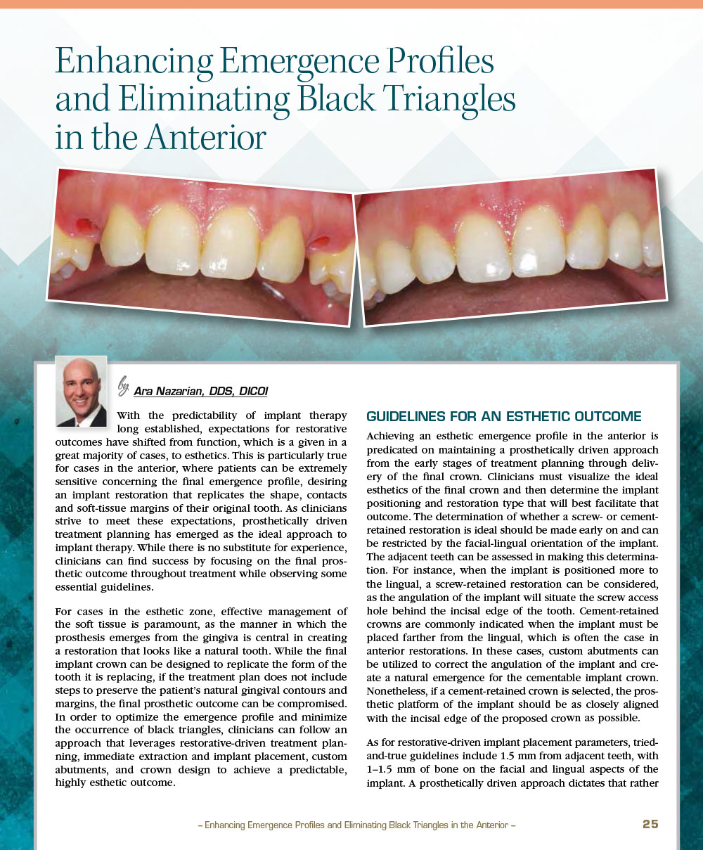 Enhancing Emergence Profiles and Eliminating Black Triangles in the Anterior