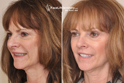 Overbite Correction without Surgery or Braces.