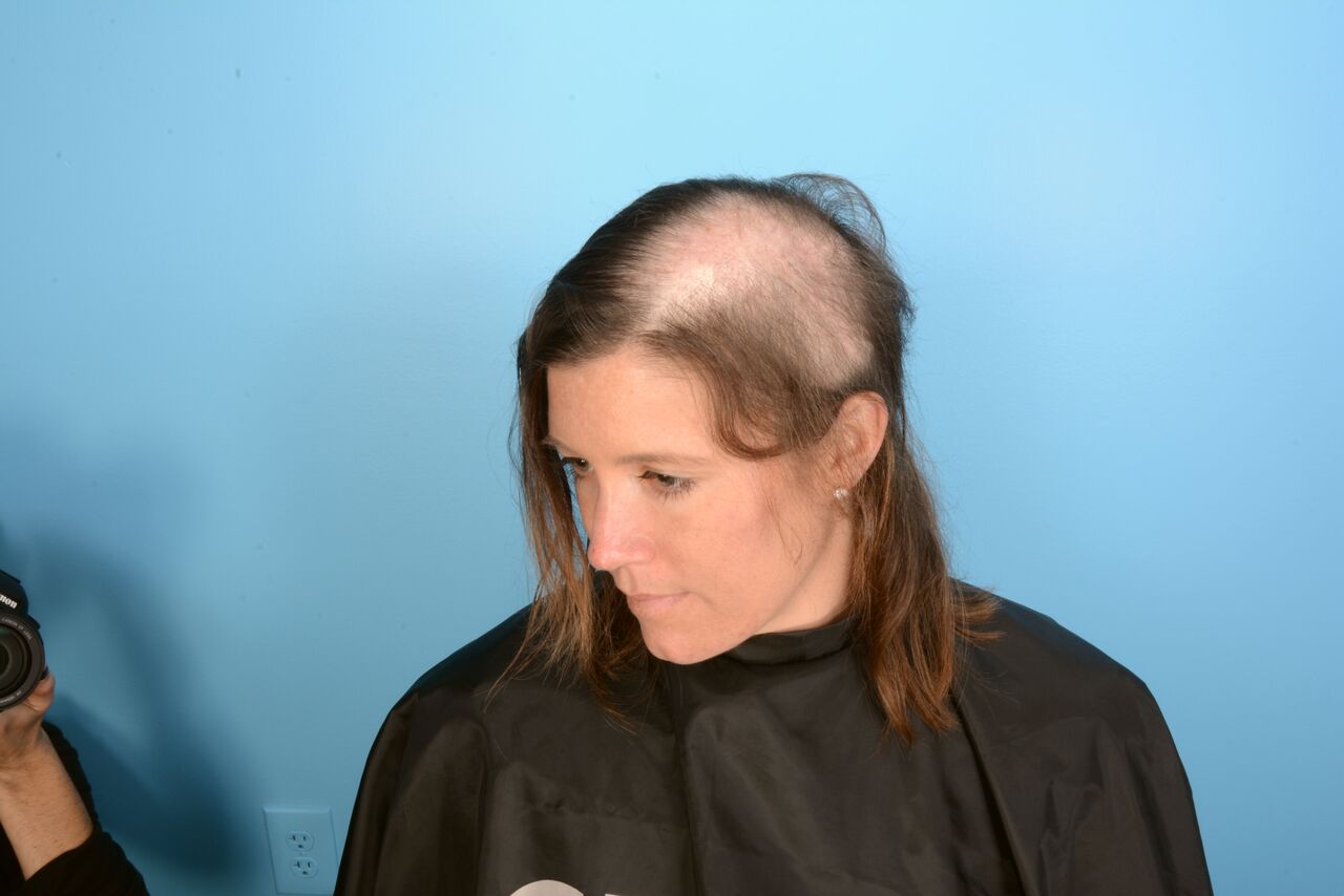 Patient's hair line shows extensive damage from cancer therapies