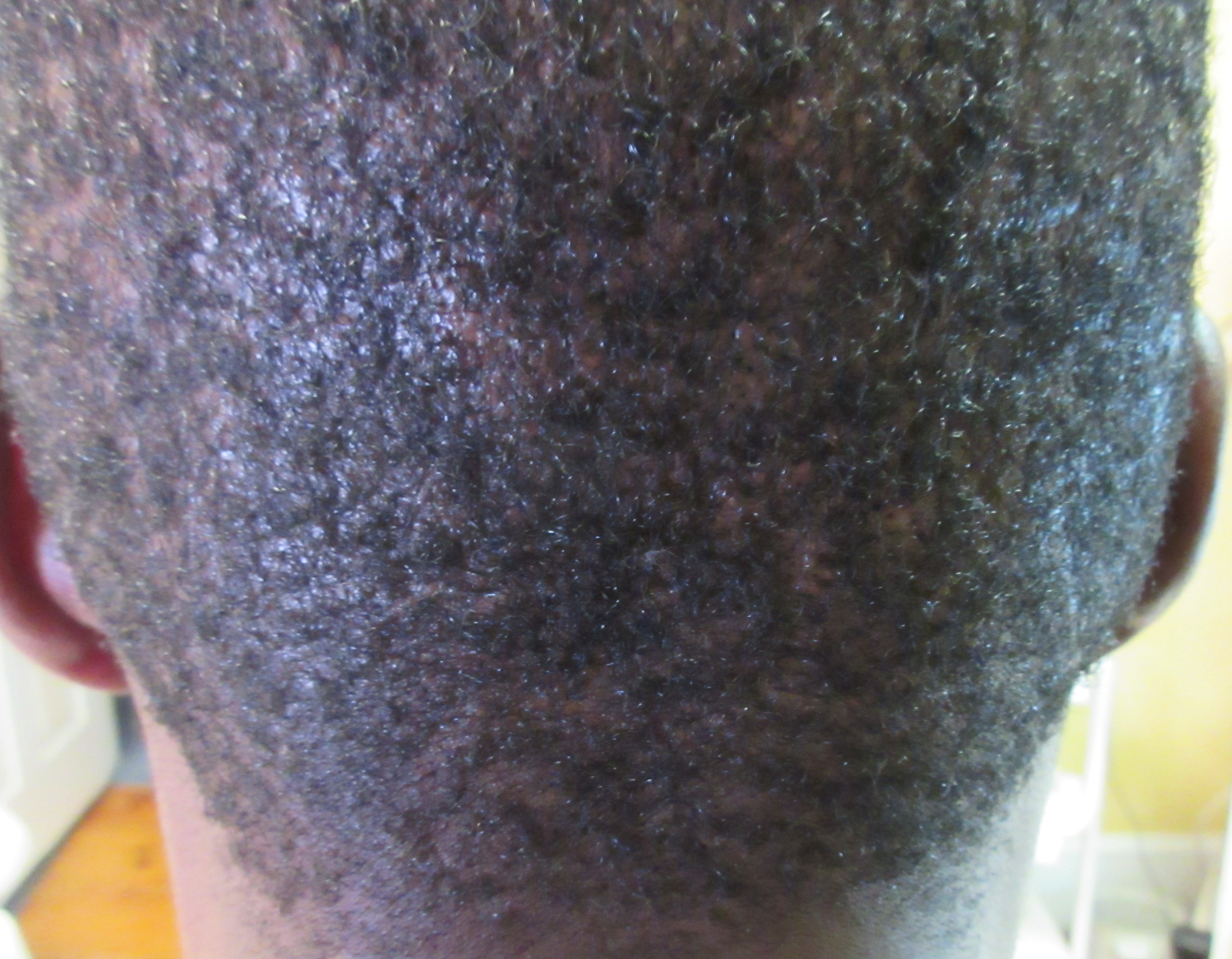Hair transplant scar