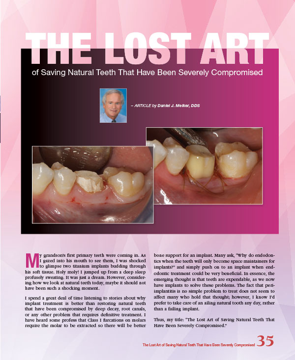 The Lost Art of Saving Natural Teeth That Have Been Severely Compromised