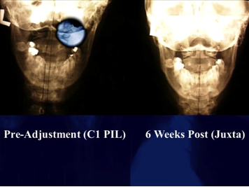 Subluxation lesion is between occiput, the base of the skull, and atlas, the top of the neck.