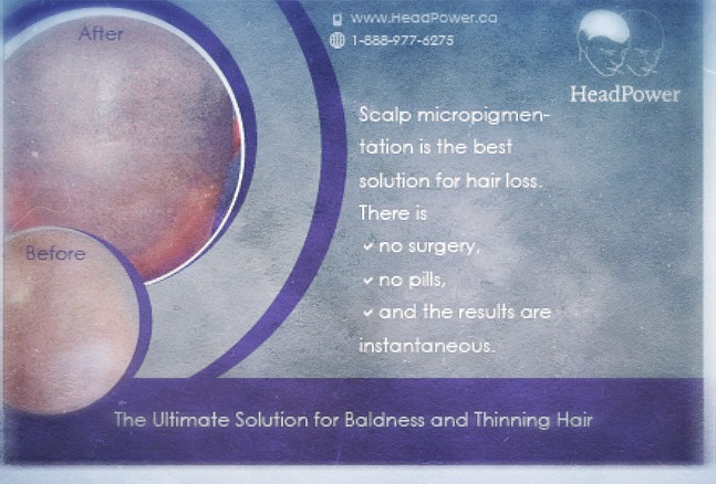 Hair Transplant FUE Alternative. SMP is Powerful!