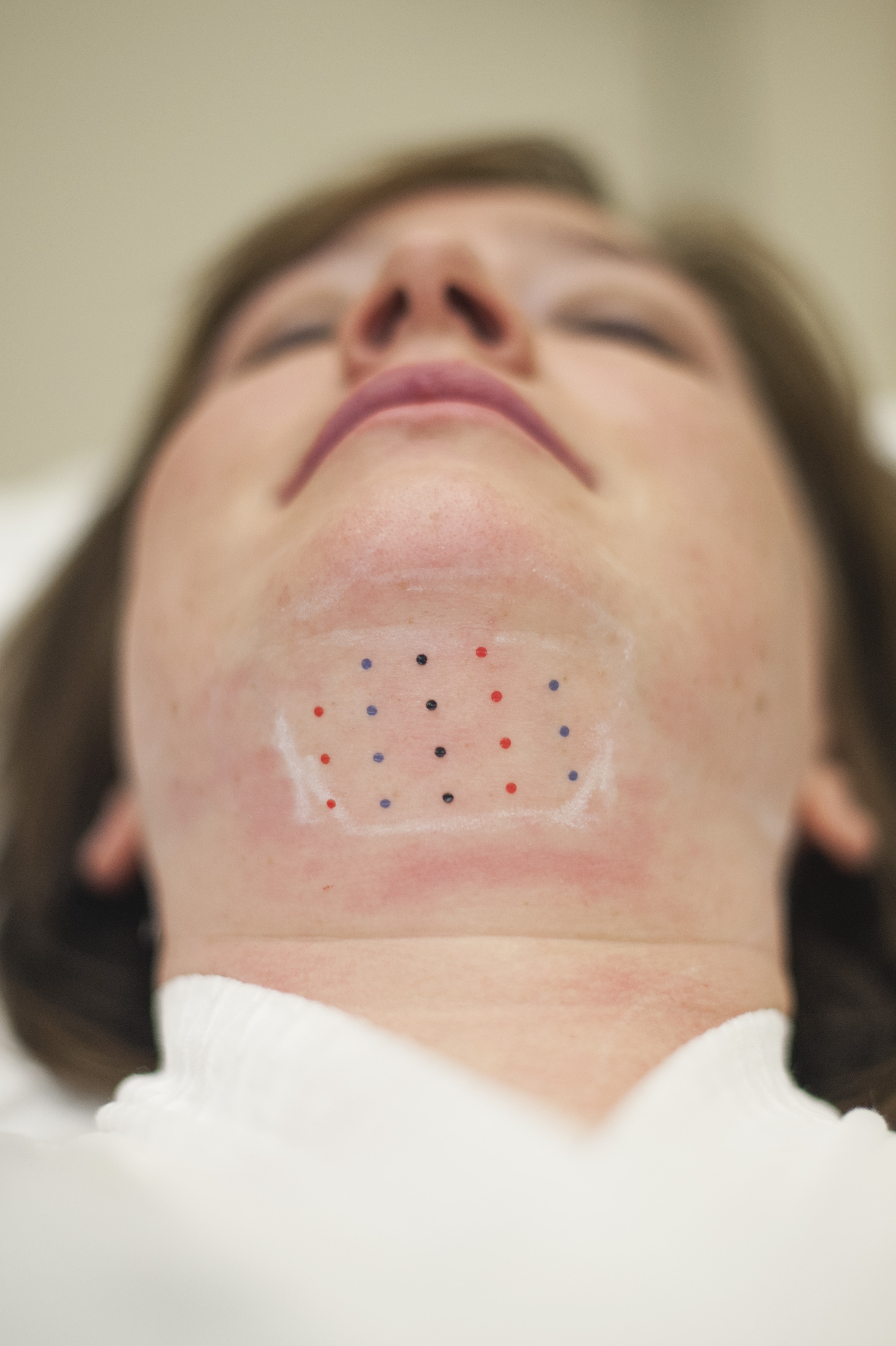 Patient marked for Kybella injection