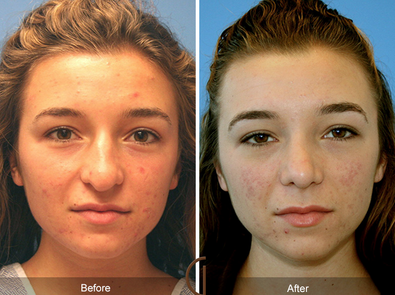 Teenage Nose Job by Top Newport Beach Facial Plastic Surgeon