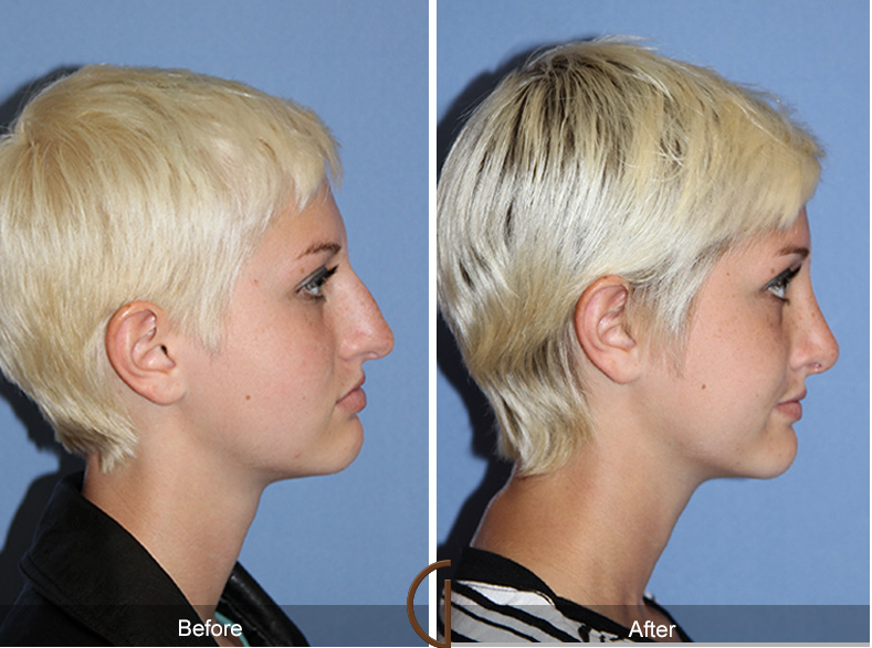 Teenage Rhinoplasty - Needed after a broken nose.