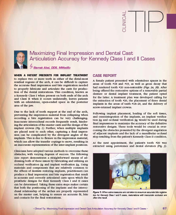 Clinical Tip: Maximizing Final Impression and Dental Cast Articulation Accuracy for Kennedy Class I and II Cases