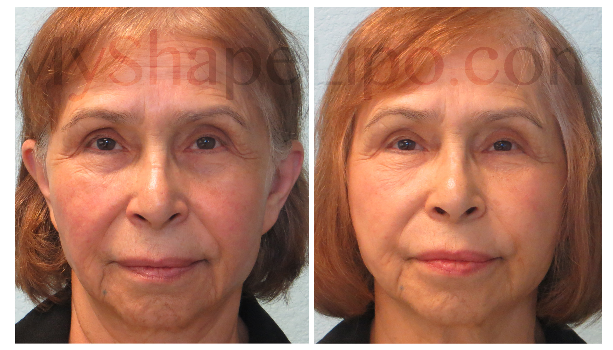 Fat Transfer to Face