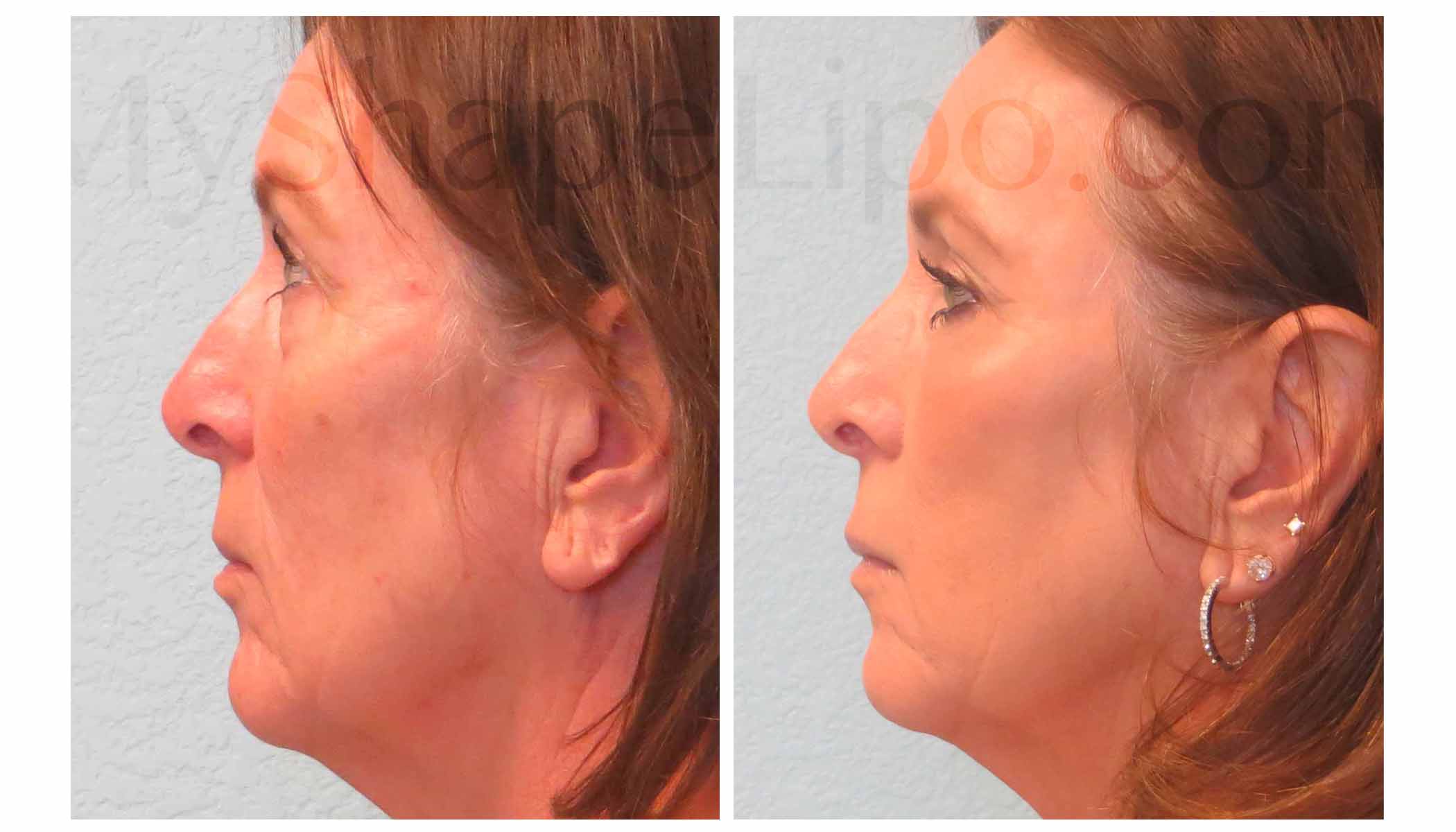 Fat Transfer to Face