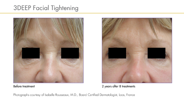 Before and After iFine treatments, courtesy of Dr. Isabelle Rousseaux