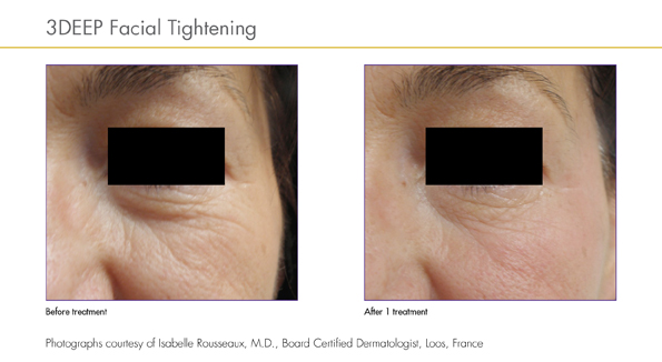 Before and After iFine treatments, courtesy of Dr. Isabelle Rousseaux