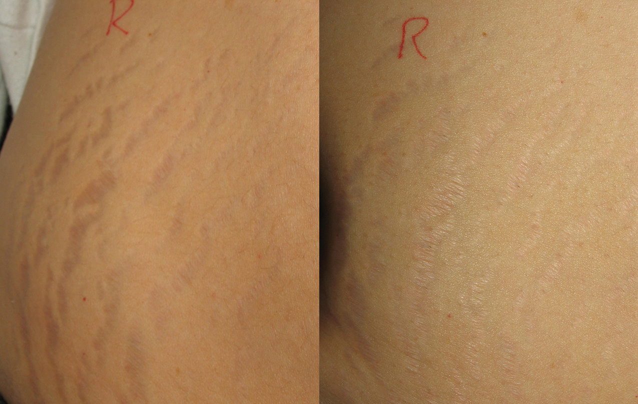 Before and After Stretch Mark Removal